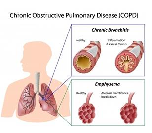 Stem Cell Therapy For Copd